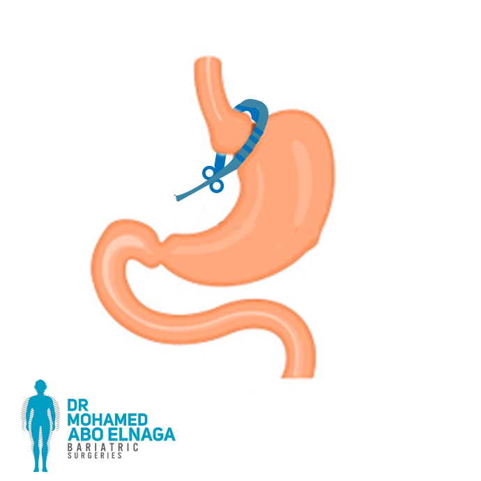 Banded Gastric Sleeve