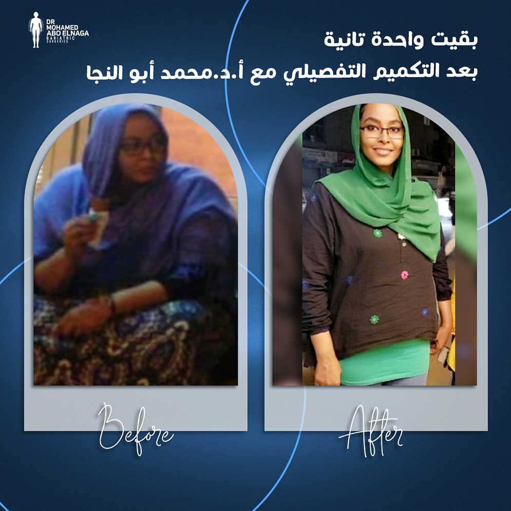 شكل-البطن-بعد-عملية-التكميم