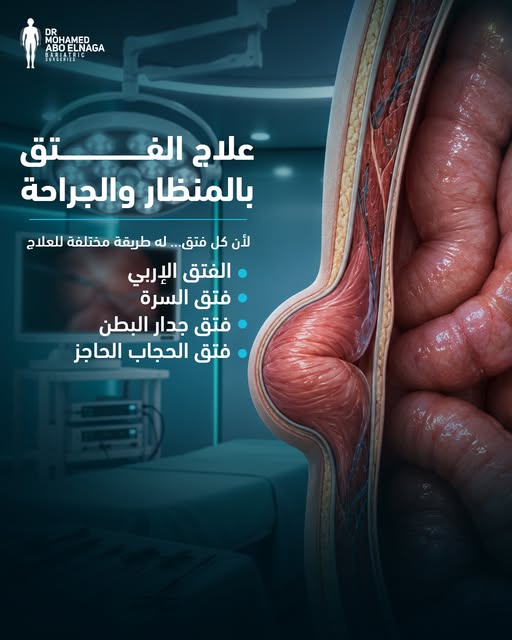 عملية-فتق-الحجاب-الحاجز-باللمنظار-