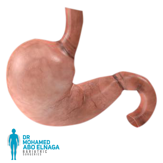 Mini Gastric Sleeve surgery