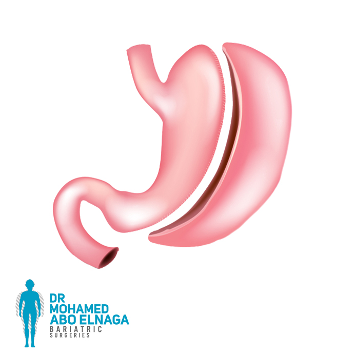 Gastric Sleeve surgery