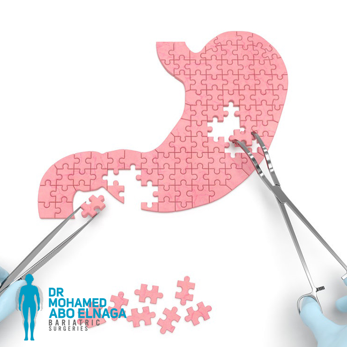 Redo bariatric surgery 