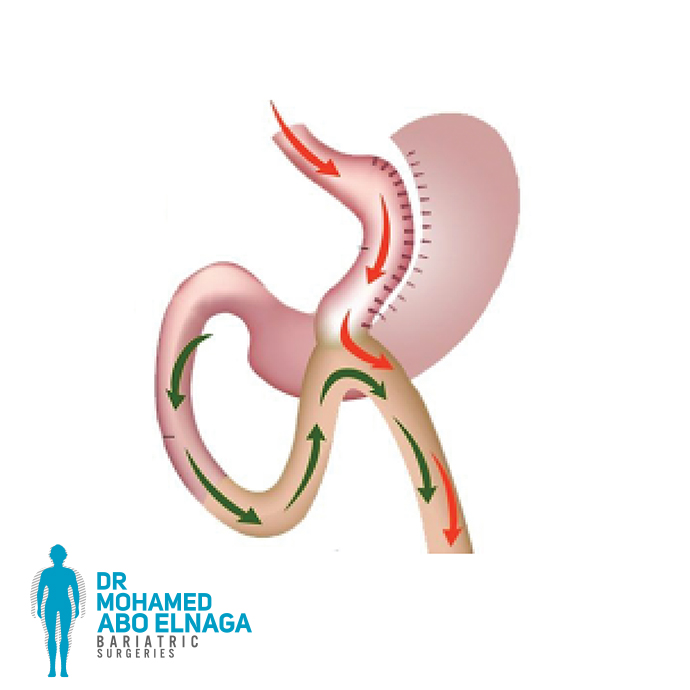 Gastric Bypass surgery