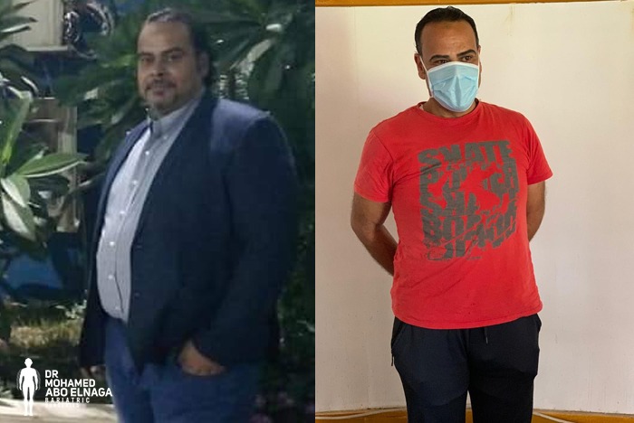 جراحات السمنة - عملية التكميم