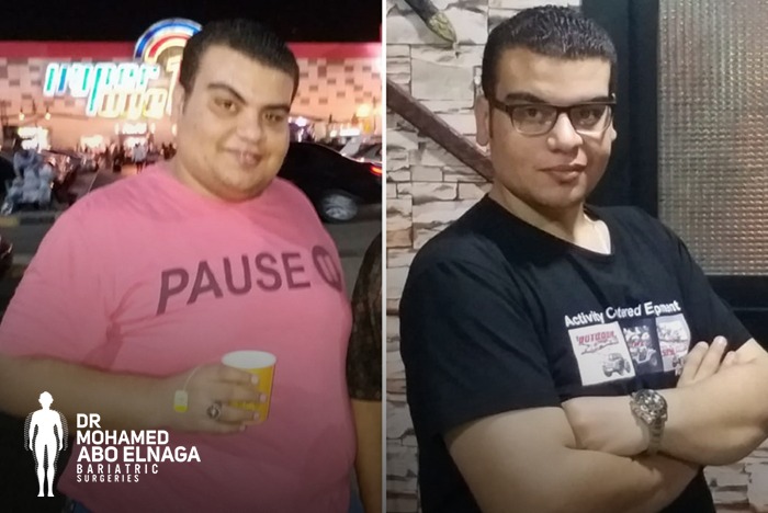 عمليات السمنة - عملية تحويل المسار